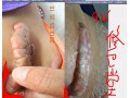 成都具有口碑的祛疤痕【薦】|最好的祛疤痕